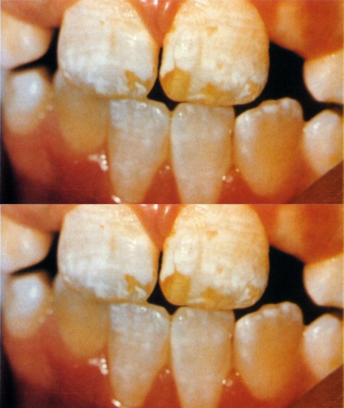 Harm to teeth from fluoride